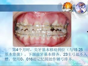 成人拔牙齿视频大全,揭秘牙齿拔除技巧与注意事项