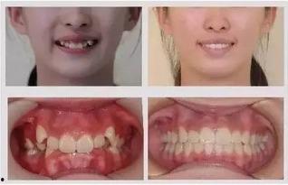 成人简单正畸方法视频,视频教程全解析