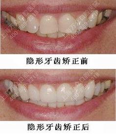 成人简单正畸方法视频,视频教程全解析