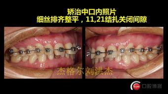 成人简单正畸方法视频,视频教程全解析